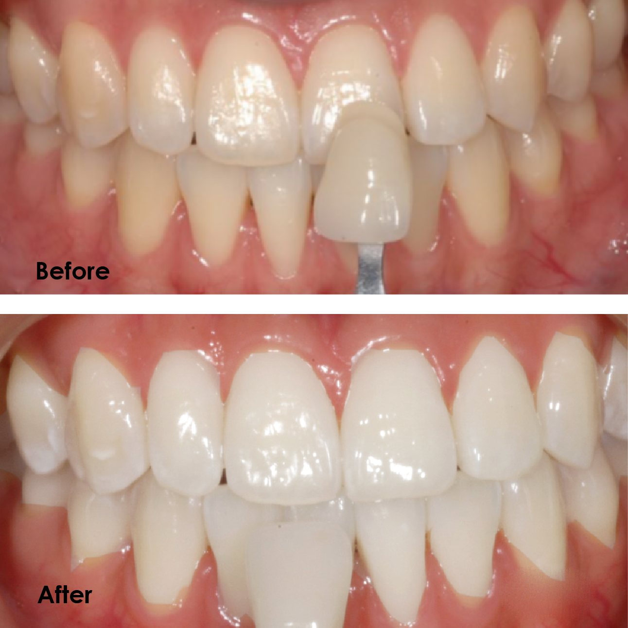 Here is the comparison of Hydra Pearl teeth whitening performance. It has faster results than other leading whitening products, a visibly whiter teeth can be seen after only 5 treatments. Lightens up to 10 shades after one treatment.