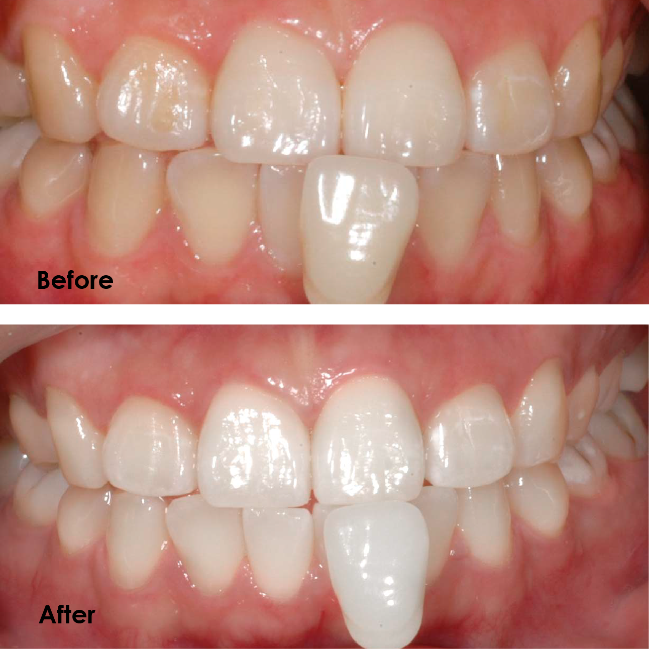 Here is the comparison of Hydra Pearl teeth whitening performance. It has faster results than other leading whitening products, a visibly whiter teeth can be seen after only 5 treatments. Lightens up to 10 shades after one treatment.